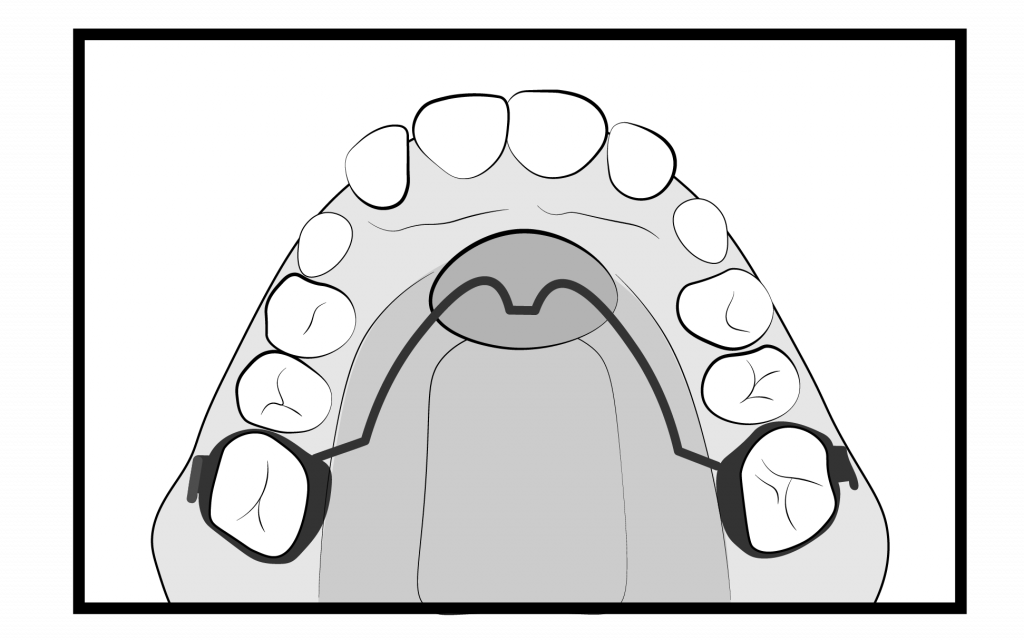 Space Maintainer Braces Treatment Steps - Cooney Orthodontics